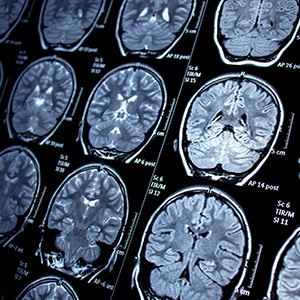 Traumatic Brain Injuries