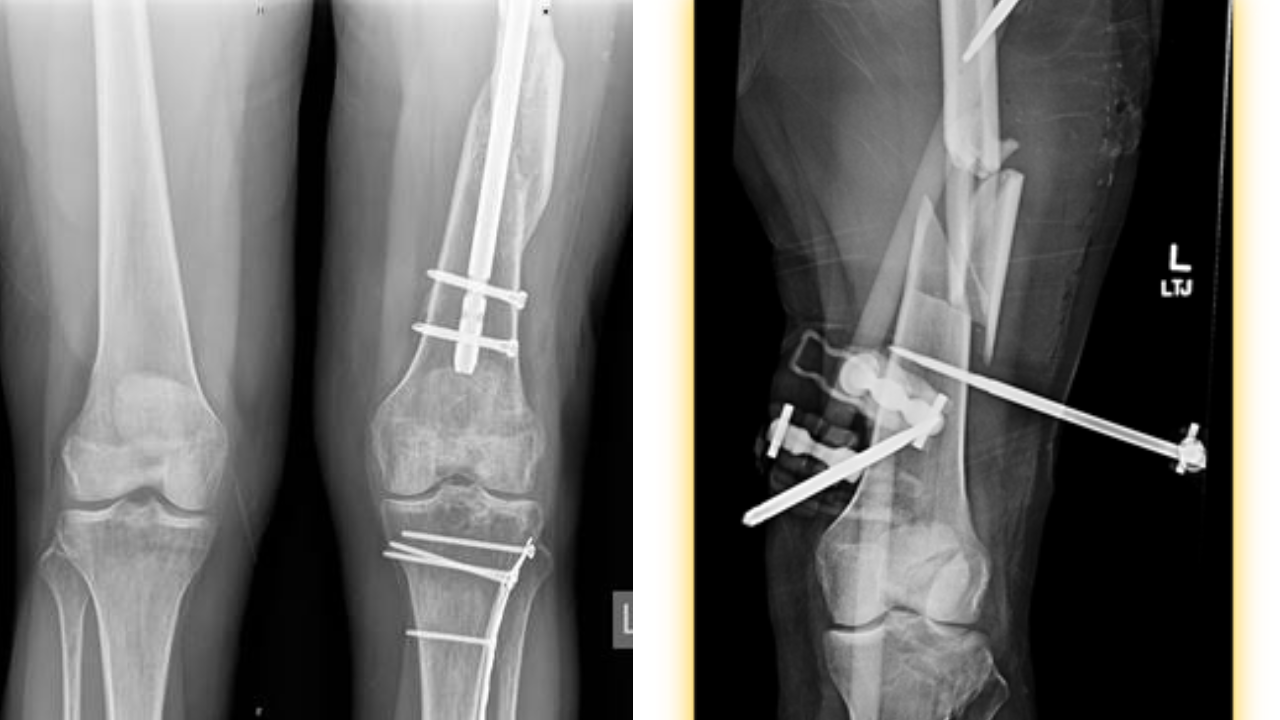 X-ray Images of Legs