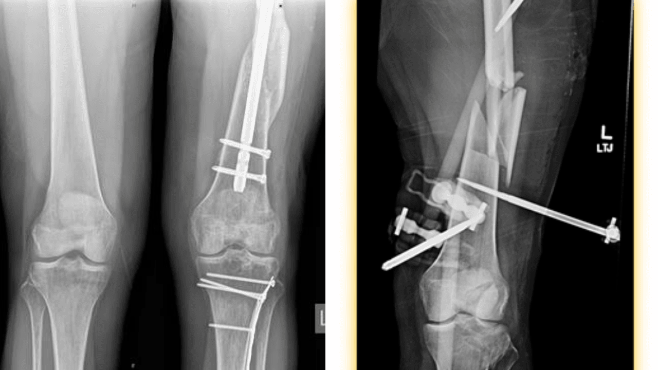 X-ray Images of Legs